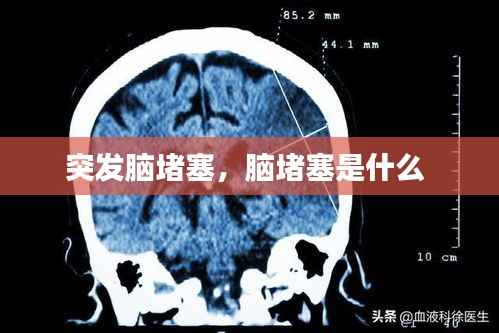 突发脑堵塞，脑堵塞是什么 